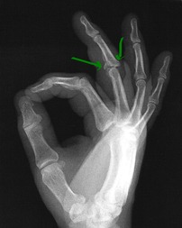 Joe’s broken hand .. finger really